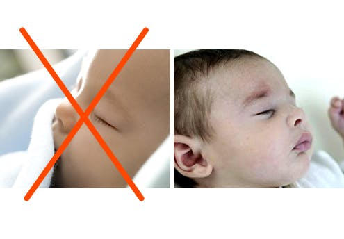 Hyperthermie bebe Hyperthermie bebe