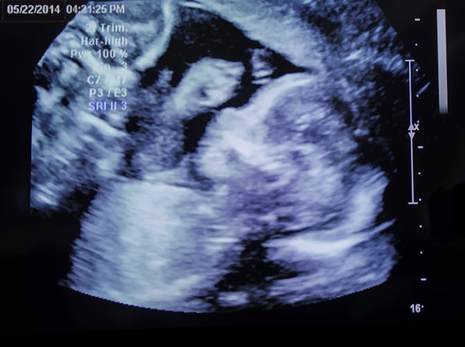 L'échographie pendant la grossesse