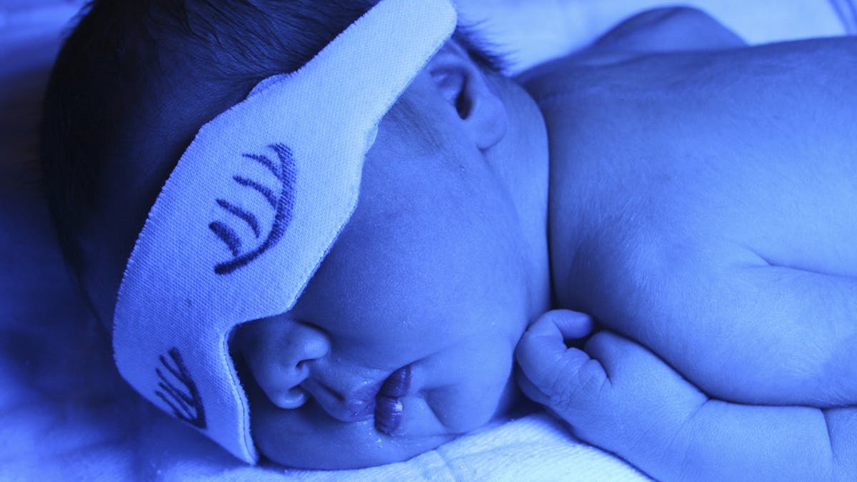 La Jaunisse Du Nourrisson Sante Bebe Parents Fr La Jaunisse Du Nourrisson Sante Bebe Parents Fr