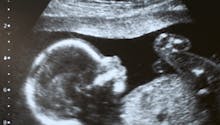 Retard de croissance in utero : retard de croissance intra utérin du fœtus