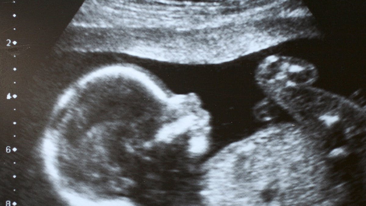 Le retard de croissance du bébé in utero