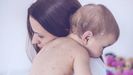 Bébé a la varicelle : bouton varicelle bébé