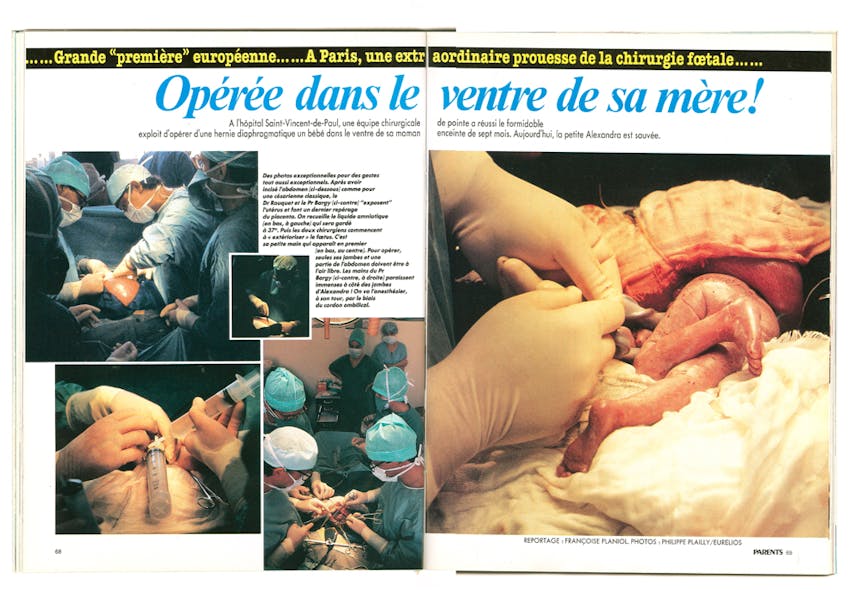 1993 : le premier bébé opéré in utero en Europe
