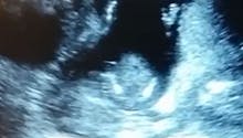 Echographie : un fœtus applaudit dans le ventre de sa  maman