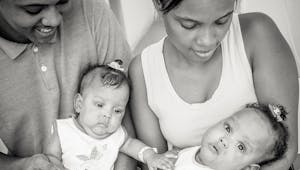 10 magnifiques photos de bébés siamois avant et après leur
  séparation