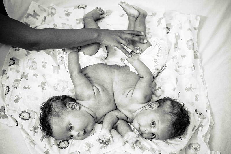 10 Magnifiques Photos De Bebes Siamois Parents Fr 10 Magnifiques Photos De Bebes Siamois Parents Fr