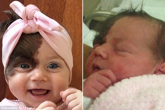 A 7 Mois Ce Bebe Va Etre Opere 7 Fois Pour Retirer Sa Tache De Naissance Faite De Poils Parents Fr A 7 Mois Ce Bebe Va Etre Opere 7 Fois Pour Retirer Sa Tache De Naissance Faite De Poils Parents Fr