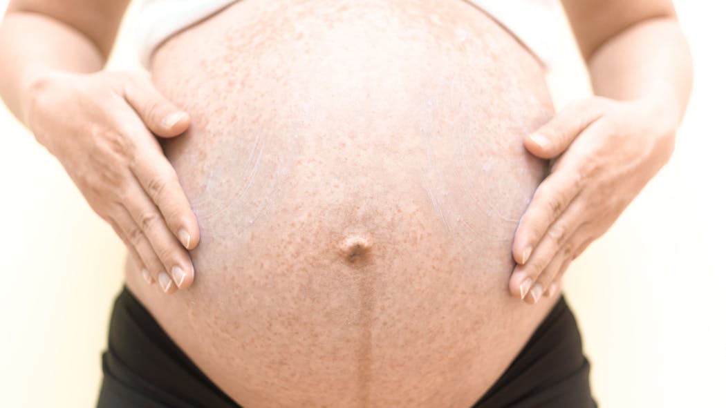 Cholestase gravidique : tout ce qu’il faut  savoir