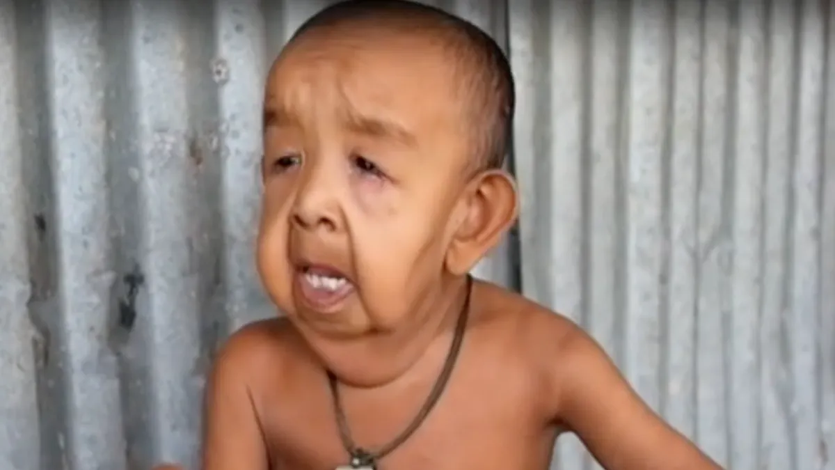 Bangladesh A 4 Ans Il Ressemble A Un Vieillard Parents Fr Bangladesh A 4 Ans Il Ressemble A Un Vieillard Parents Fr