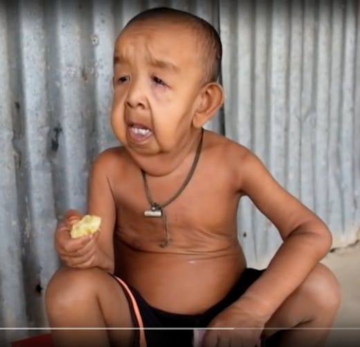 Bangladesh: Un petit garçon de 4 ans atteint d'une maladie qui lui