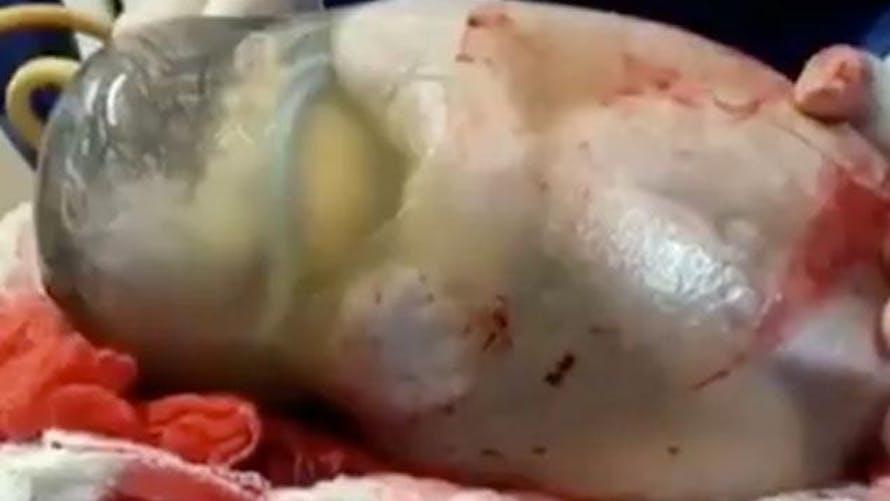 Vidéo : un bébé nait entièrement enveloppé de son sac
  amniotique