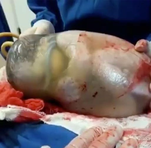 Vidéo : un bébé nait entièrement enveloppé de son sac
  amniotique