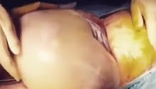 Vidéo : l’impressionnante naissance par césarienne
  d’un bébé dans son sac amniotique