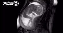 Un bébé étire ses jambes dans le ventre de sa mère (VIDEO)