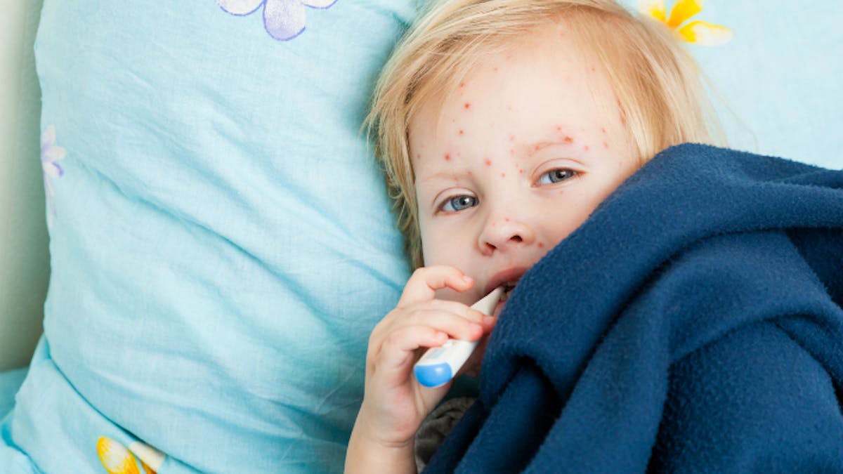 Varicelle Le Virus Progresse Dans Plusieurs Regions Parents Fr Varicelle Le Virus Progresse Dans Plusieurs Regions Parents Fr