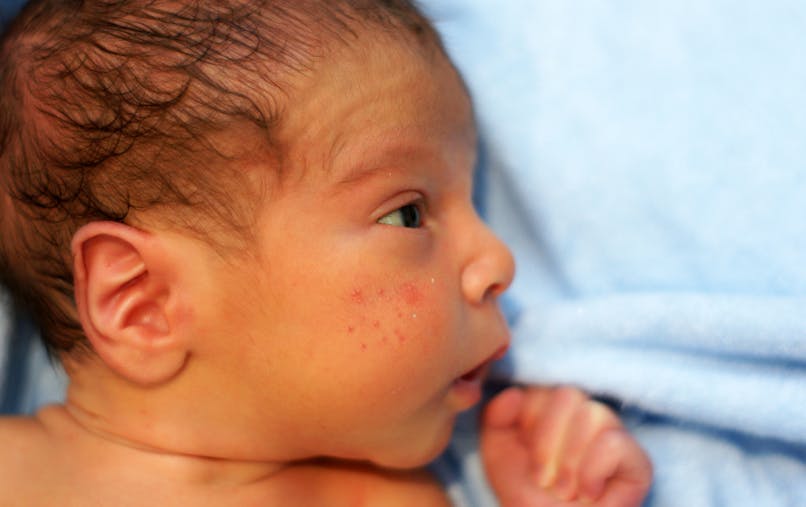 Acne Du Nourrisson Causes Symptomes Traitement Parents Fr Acne Du Nourrisson Causes Symptomes Traitement Parents Fr
