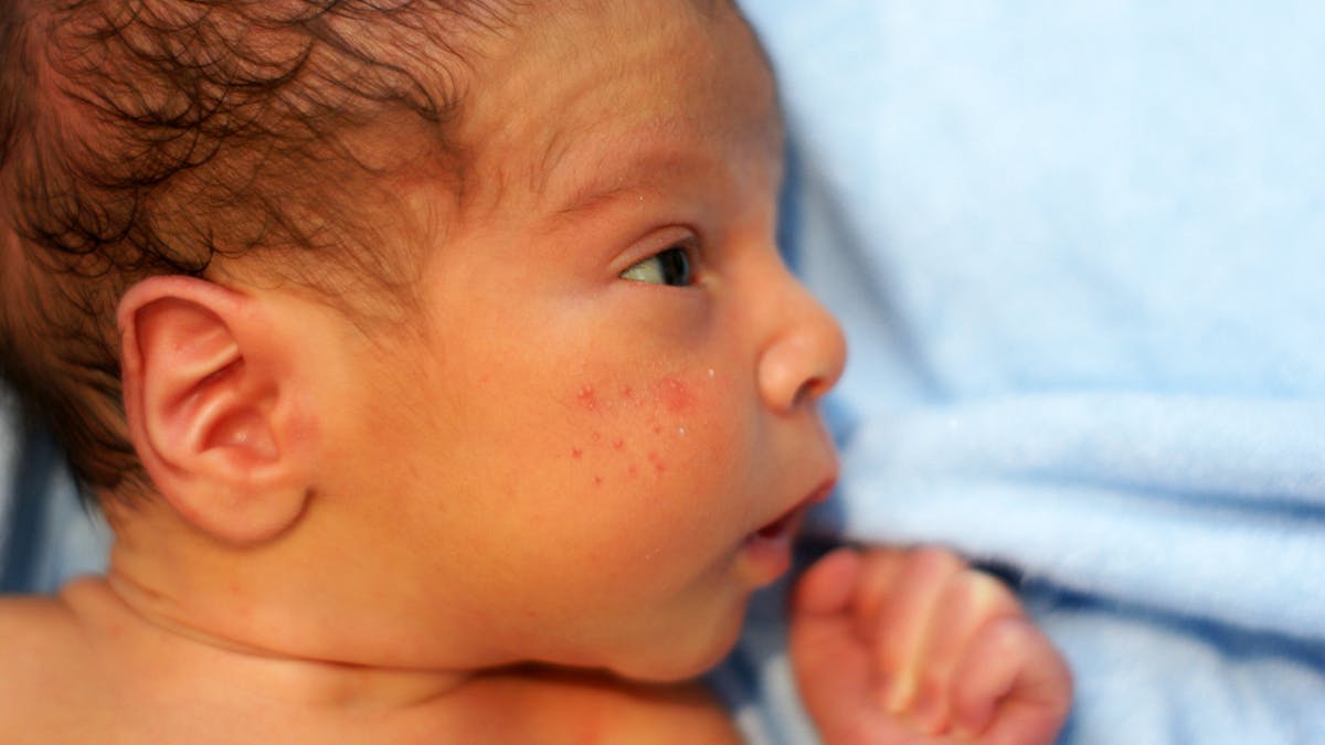 Acne Du Nourrisson Causes Symptomes Traitement Parents Fr Acne Du Nourrisson Causes Symptomes Traitement Parents Fr