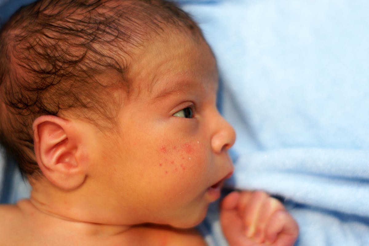 Acné du nourrisson : causes, symptômes, traitement de l'acné du ...