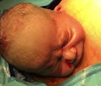 Le bébé sort en douceur du ventre : l'étonnante vidéo d'une césarienne