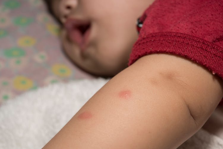 piqûre de moustique sur le bras d'un enfant
