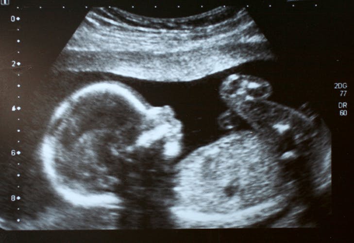 échographie de foetus
