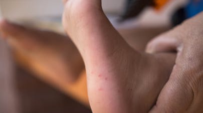 Les Mycoses Chez L Enfant Et Le Bebe Parents Fr
