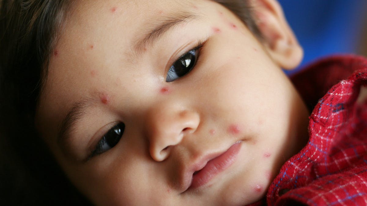 Une Famille Debarquee D Un Avion Car Leur Bebe A La Varicelle Parents Fr Une Famille Debarquee D Un Avion Car Leur Bebe A La Varicelle Parents Fr