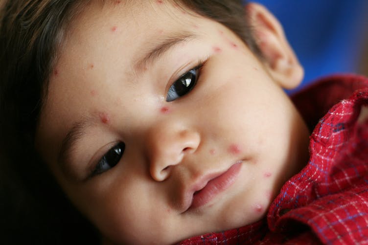 bébé a la varicelle