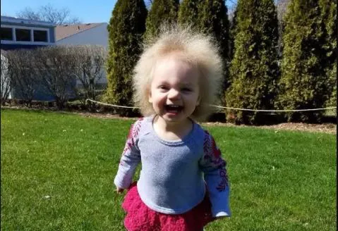 L Incroyable Chevelure D Un Bebe Atteint Du Syndrome Des Cheveux Incoiffables Images Parents Fr L Incroyable Chevelure D Un Bebe Atteint Du Syndrome Des Cheveux Incoiffables Images Parents Fr