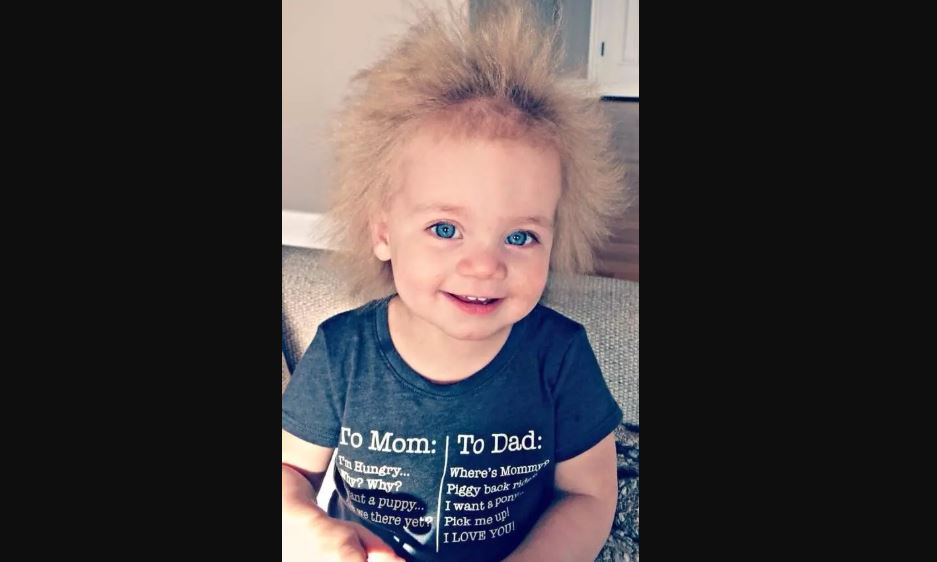 L Incroyable Chevelure D Un Bebe Atteint Du Syndrome Des Cheveux Incoiffables Images Parents Fr