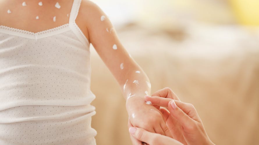 La varicelle : comment la reconnaître chez l'enfant