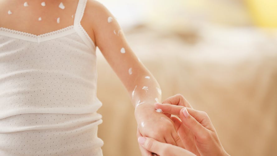 Varicelle Enfant Les Symptomes Chez L Enfant Parents Fr Varicelle Enfant Les Symptomes Chez L Enfant Parents Fr