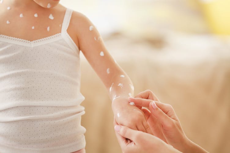 La varicelle : comment la reconnaître chez l'enfant