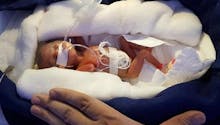 Inde : la miraculeuse naissance d'une petite fille de 400 grammes