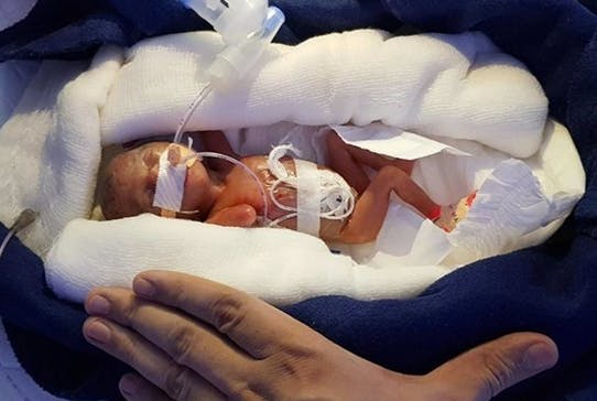 Le Combat D Un Bebe Premature En Inde Parents Fr Le Combat D Un Bebe Premature En Inde Parents Fr