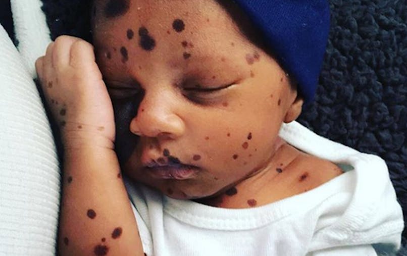 La Lettre Bouleversante D Une Maman A Son Bebe Couvert De Grains De Beaute Parents Fr La Lettre Bouleversante D Une Maman A Son Bebe Couvert De Grains De Beaute Parents Fr