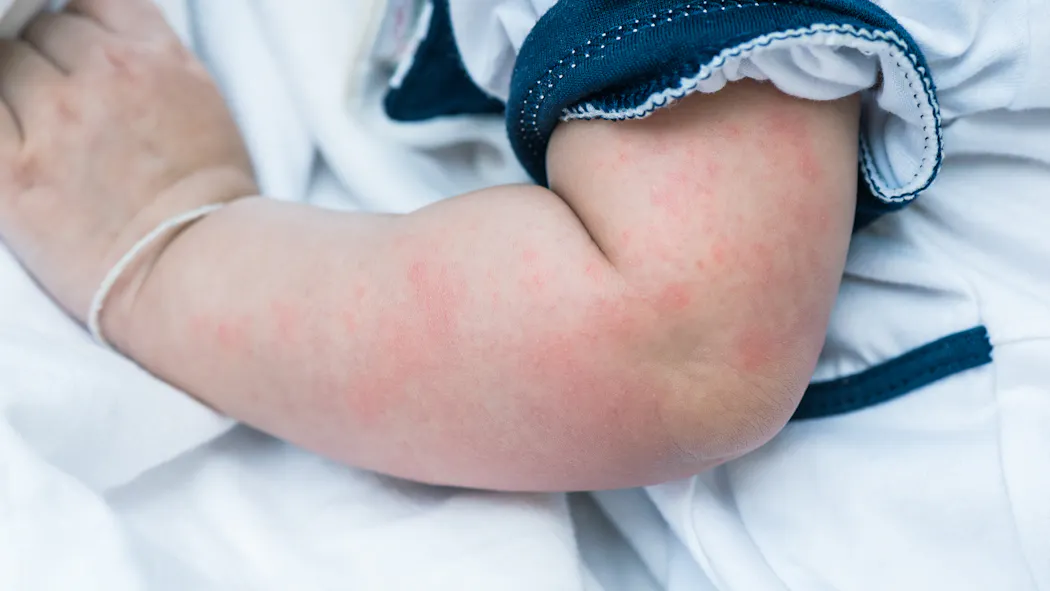 Urticaire : le point sur les causes, symptômes et traitements de cette ...