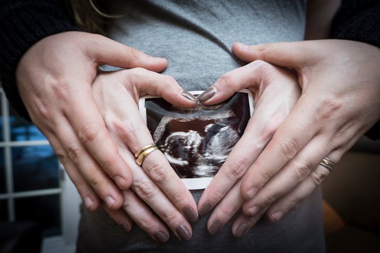 Trisomie : on lui conseille d’avorter parce que son bébé serait atteint de trisomie 21, elle accouche d’un bébé non trisomique