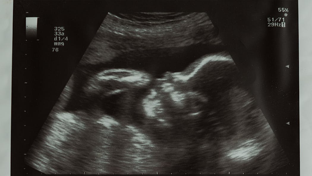 10 Semaine De Grossesse 12 Sa De Grossesse 10eme Semaine Parents Fr 10 Semaine De Grossesse 12 Sa De Grossesse 10eme Semaine Parents Fr