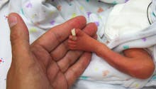 Né à 23 semaines de grossesse, ce bébé a déjoué tous les pronostics des médecins