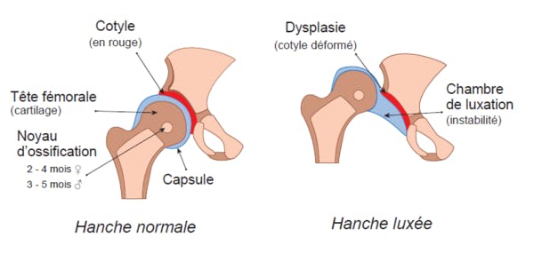 Luxation Congenitale De La Hanche Depistage Des La Naissance Parents Fr Luxation Congenitale De La Hanche Depistage Des La Naissance Parents Fr
