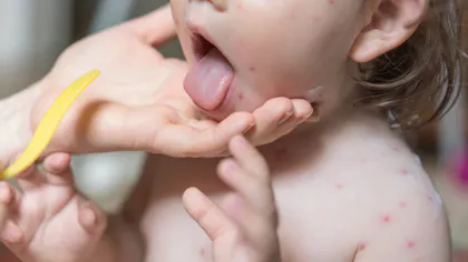 Herpes Labial L Avertissement D Une Maman Dont La Fillette A Ete Gravement Affectee Parents Fr Herpes Labial L Avertissement D Une Maman Dont La Fillette A Ete Gravement Affectee Parents Fr