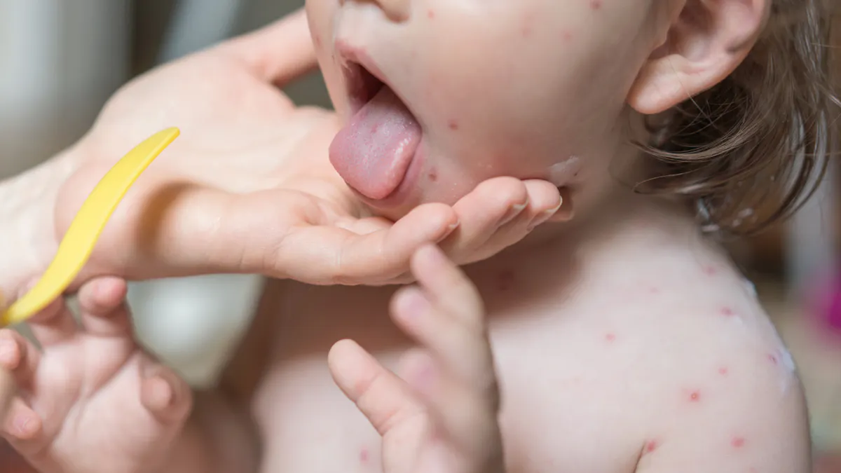 Herpes Labial L Avertissement D Une Maman Dont La Fillette A Ete Gravement Affectee Parents Fr Herpes Labial L Avertissement D Une Maman Dont La Fillette A Ete Gravement Affectee Parents Fr