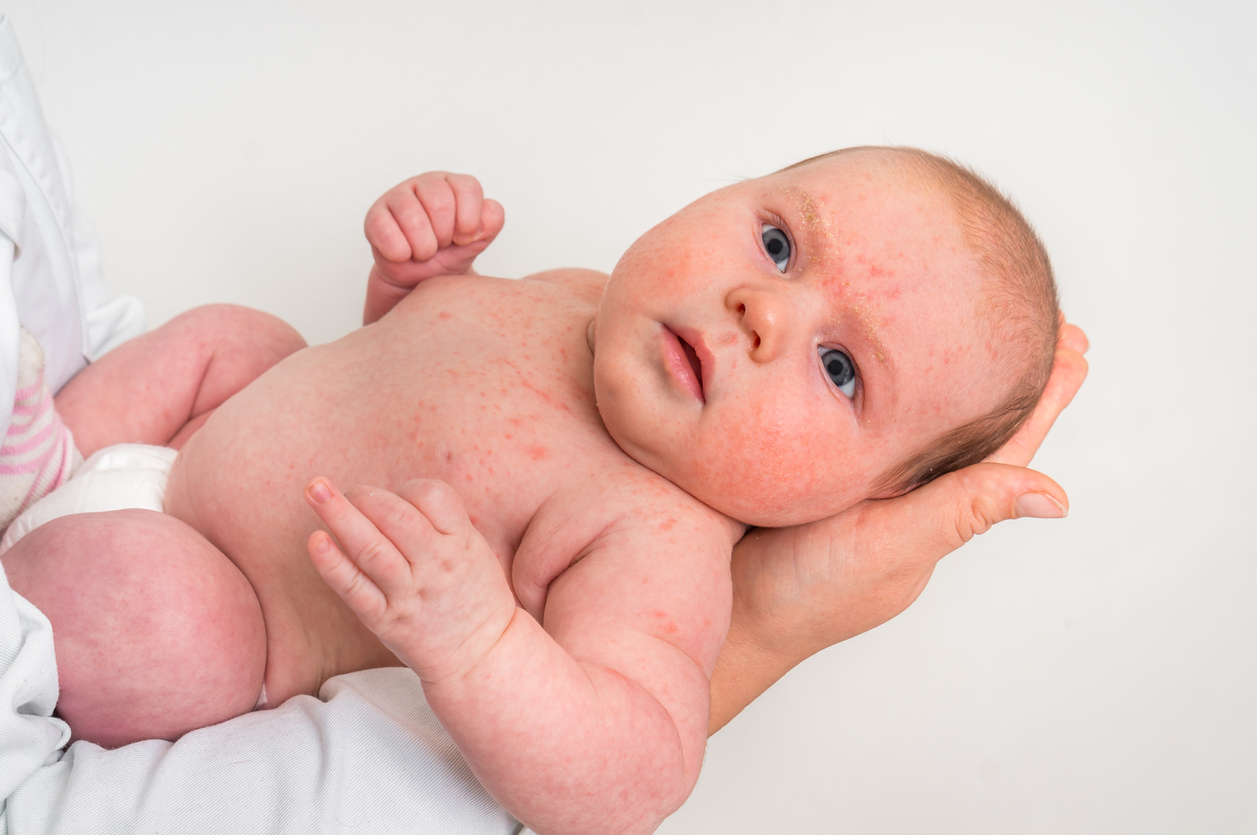 La Rubeole Chez Le Bebe Parents Fr