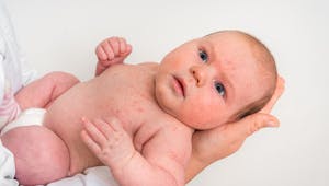 La rubéole chez bébé : comment le soigner ?