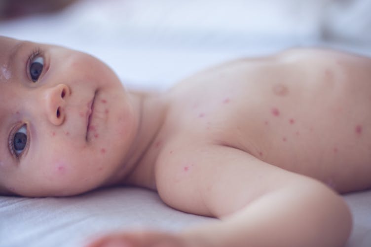 bébé varicelle