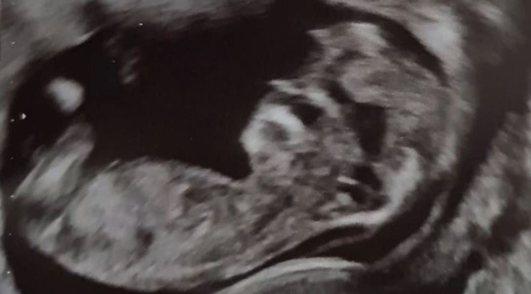 Echographie de grossesse : un couple choqué, leur bébé ressemble à Donald Trump