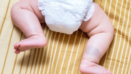 L Eczema Et Probleme De Peau Chez Le Bebe Et L Enfant Demangeaisons Chez Les Enfants Parents Fr L Eczema Et Probleme De Peau Chez Le Bebe Et L Enfant Demangeaisons Chez Les Enfants Parents Fr