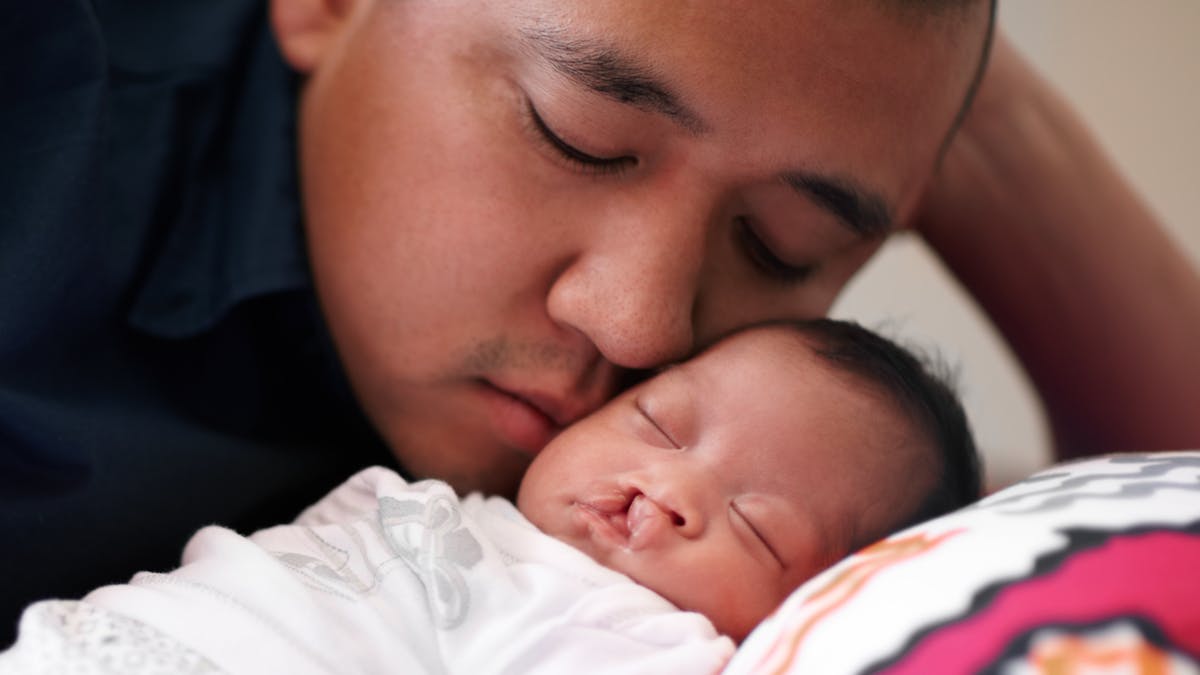 Un bébé atteint d'une fente labio-palatine dort avec son père.