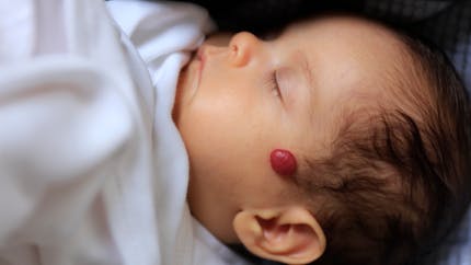 Bébé a un hémangiome : comment le reconnaître et le soigner ?